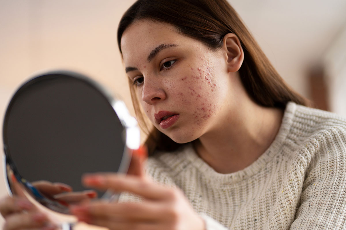 O Que é Acne? Descubra as Causas, Tipos, Tratamentos e Prevenção