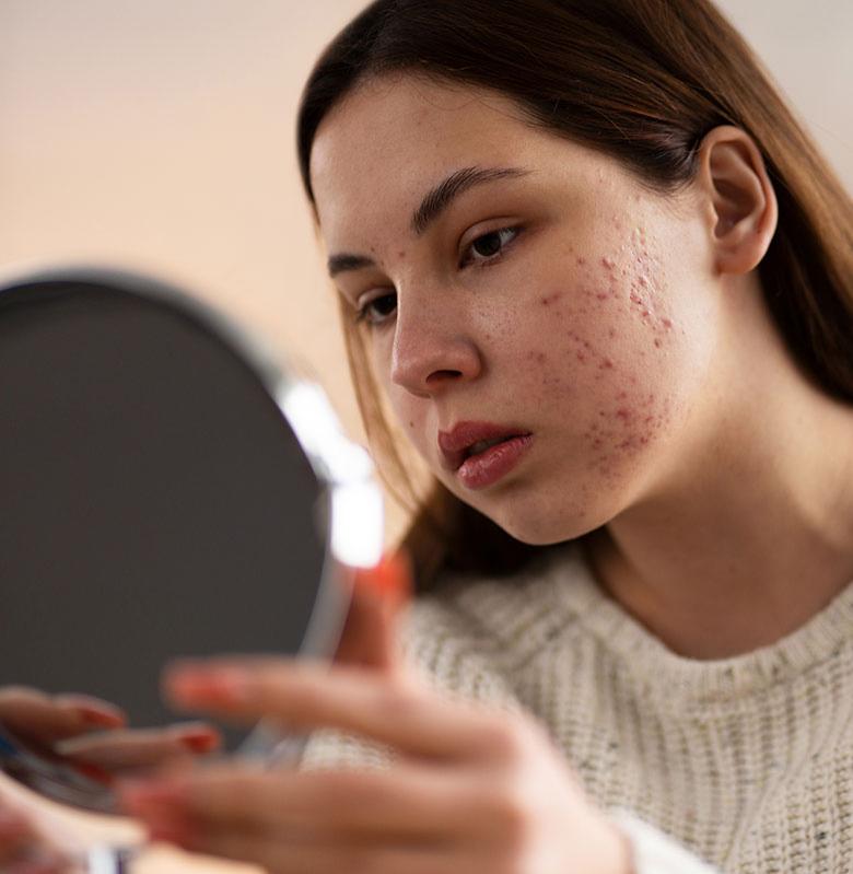 Acne - Centro Médico Jardins - Dermatologista em Vitória - ES